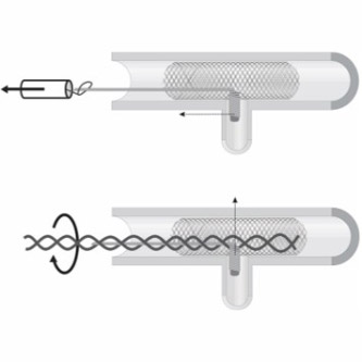 Snare retrieval X Twin-Guidewire Method 