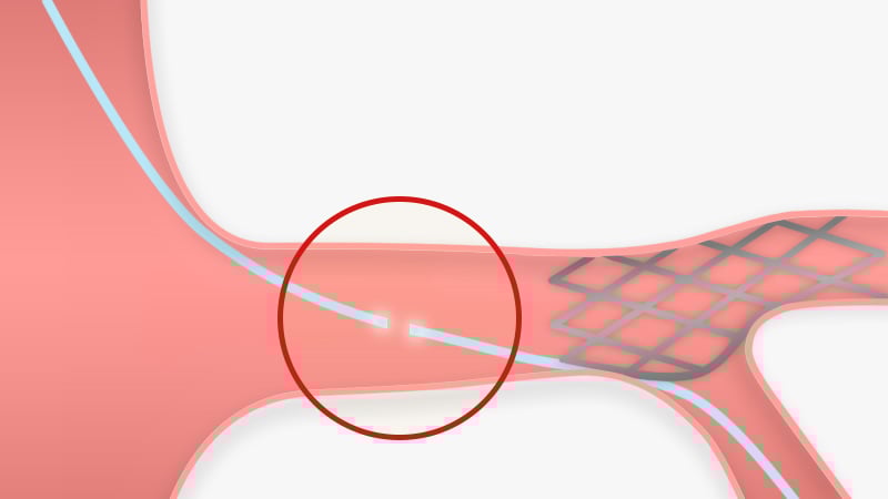 complications jailed GW confined to coronary illustration