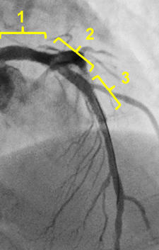 Stent well apposition and fully expansion