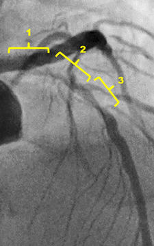 360 degree calcification at middle part of LAD