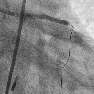 One stent strategy
