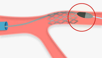 complications rota wire under struts: illustration