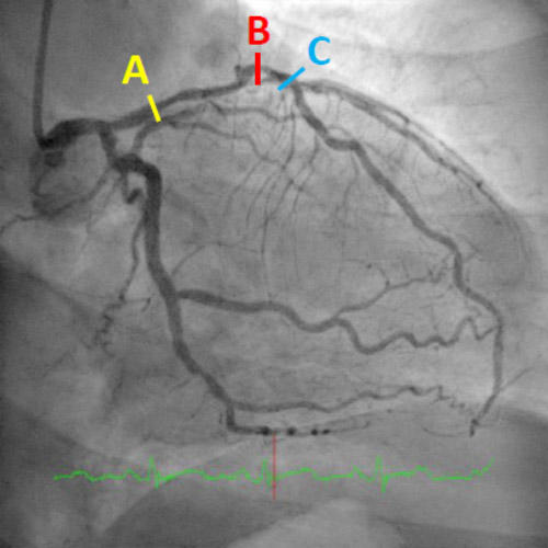 Diffuse disease from proximal to mid LAD  