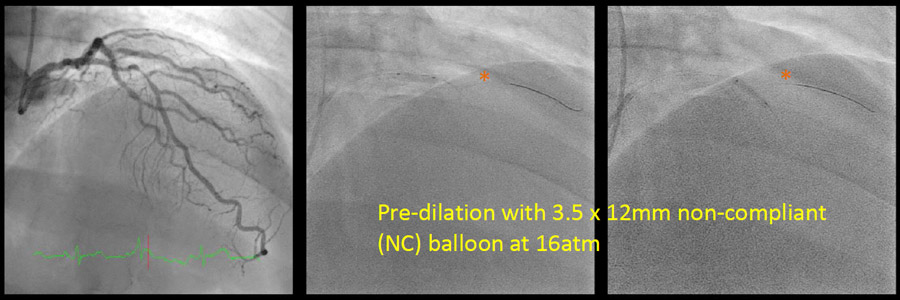 Pre-dilatation with 3.5x 12mm non-compliant (NC) balloon at 16atm