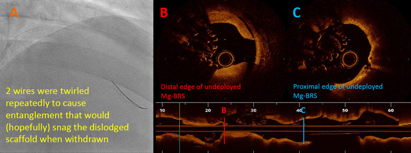 A: 2 wires were twirled repeatedly to cause entanglement that would (hopefully) snag the dislodged scaffold when withdrawn B: Distal edge of undeployed Mg-BRS C: Proximal edge of undeployed Mg-BRS