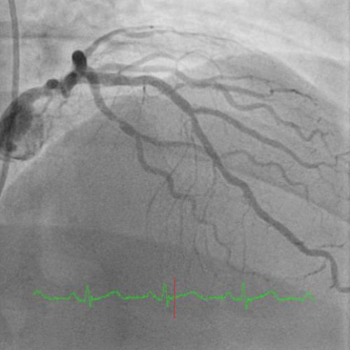 Final angiographic appearance