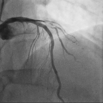 Figure 3.1. Guiding catheter lost position