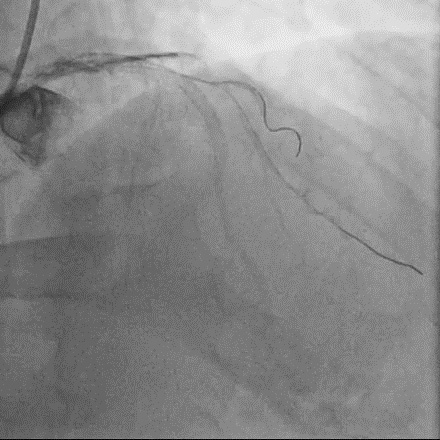 Figure 3.2. Guiding catheter lost position