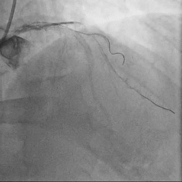 Figure 3.2. Guiding catheter lost position