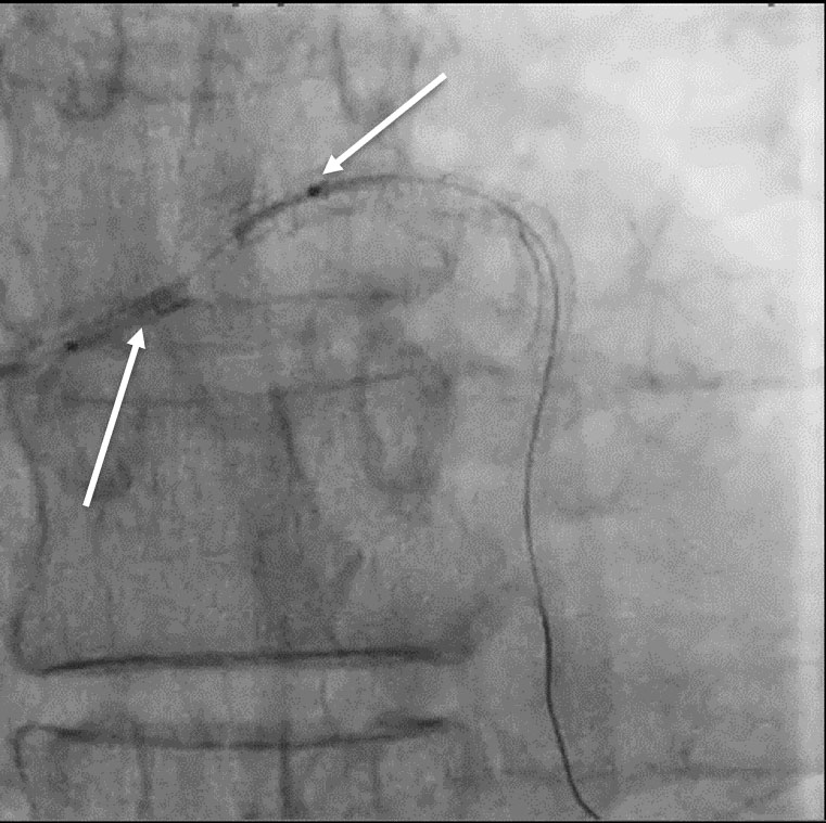 Figure 4. Diagonal branch PCI