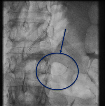 Figure 5.1. Dislocated stent migrated to left renal artery