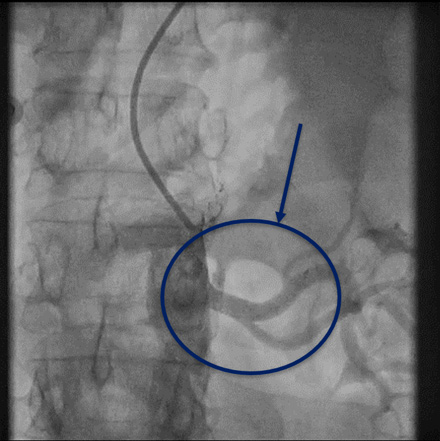 Figure 5.2. Dislocated stent migrated to left renal artery