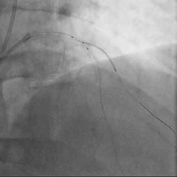 Figure 6.1. 2 25x24 mm DES successfully implanted