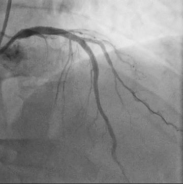 Figure 6.2.  2 25x24 mm DES successfully implanted