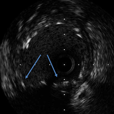 Figure 7.1. Left main IVUS after DB PCI