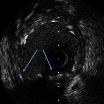 Figure 7.1. Left main IVUS after DB PCI