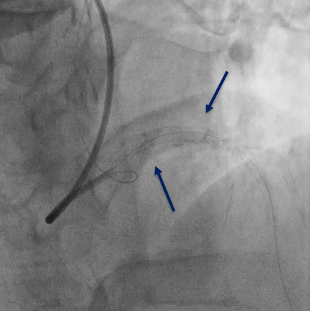 Figure 7.2. Left main IVUS after DB PCI