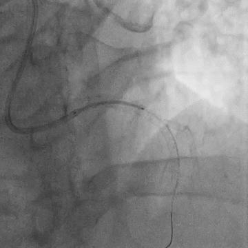 Figure 8.1. Final angiography