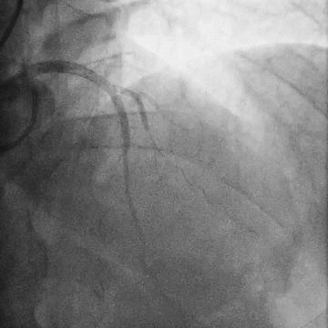 Figure 8.2. Final angiography