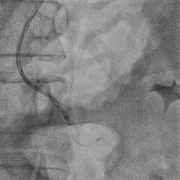Figure 9.1. Renal artery stent extraction