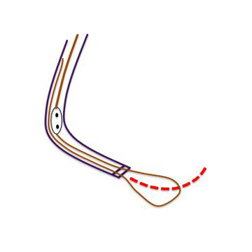 Figure 9.2. Renal artery stent extraction