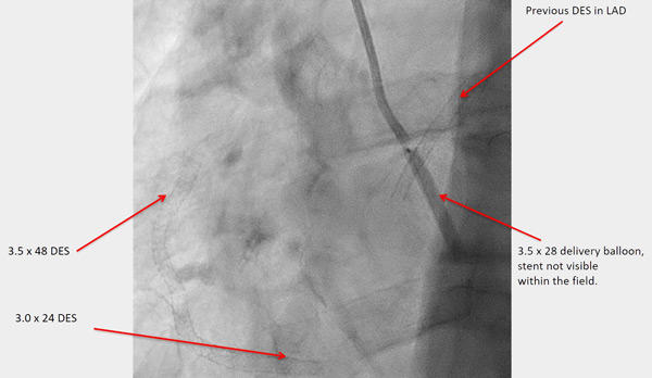 Figure 6. Previous DES in LAD
