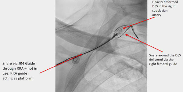 Figure 8. Attempt to rewire the stent