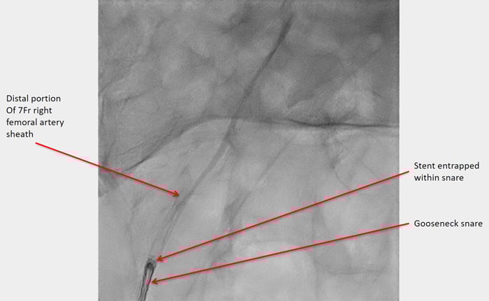 Figure 9. Stent entrapment