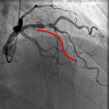 Figure 3. Tortuous and calcified lesion in middle of LAD