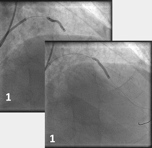 Figure 4.1. Radial access