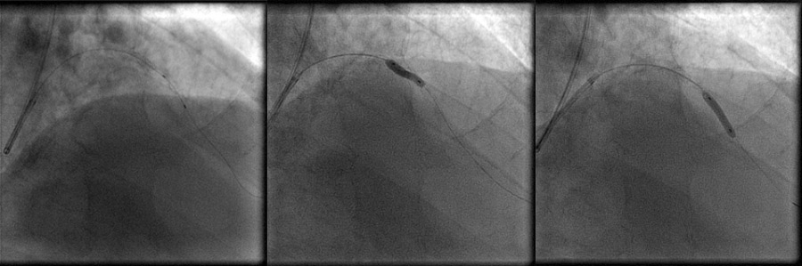 Figure 5.1. Stent pass tried to distal edge unsuccessfully