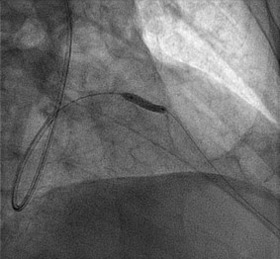 Figure 6.3. Crushing the stent