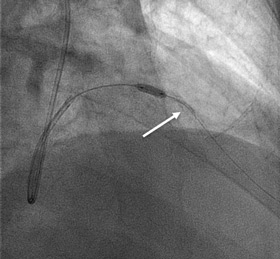 Figure 6.5. Crushing the stent