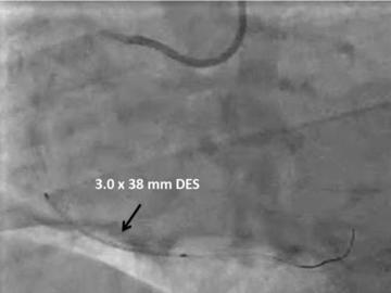 Figure 3.1. 3.0x38mm DES