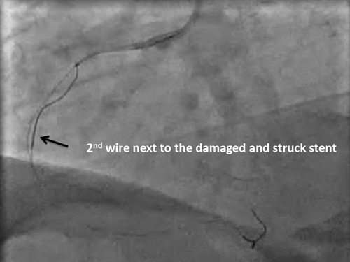Figure 5 - 2nd wire next to the damaged and struck stent