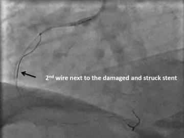 Figure 5 - 2nd wire next to the damaged and struck stent