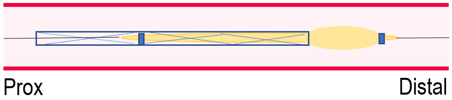 Partial stent loss: inflate stent balloon
