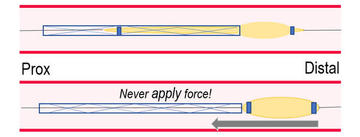 Partial stent loss: balloon partially within stent