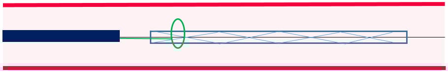Total stent loss with GW in-situ: snaring technique