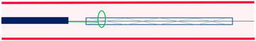 Total stent loss with GW in-situ: snaring technique