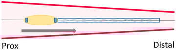 Total stent loss GW in-situ: stent vessel mismatch