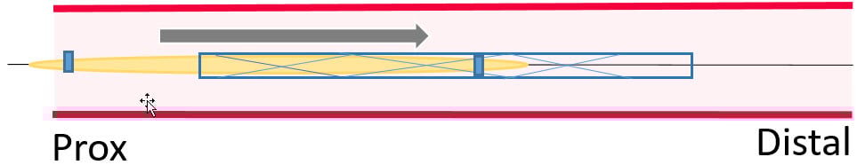 Total stent loss GW in-situ: stent vessel sizing
