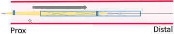 Total stent loss GW in-situ: stent vessel sizing