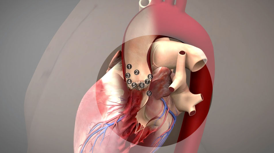 Anatomy oh the aortic valvar complex