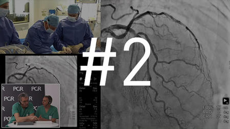 A patient with a bifurcation lesion requiring a provisional stent with or without side branch stenting