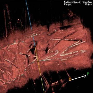 A surprising image of 3D optical frequency domain imaging in left main bifurcation