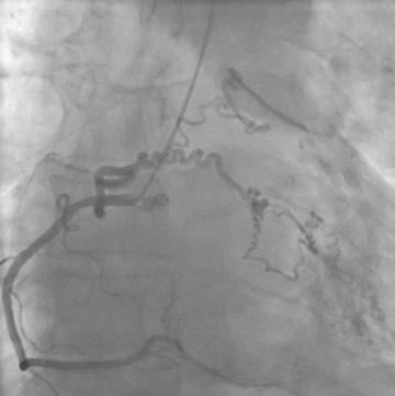 An unusual cause of inferior ischemia