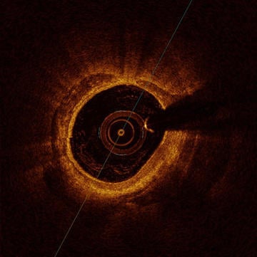 In-stent restenosis but no sign of a stent
