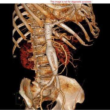Juxtarenal aneurysm