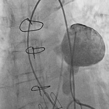 Poor outcome after surgical aortic valve replacement